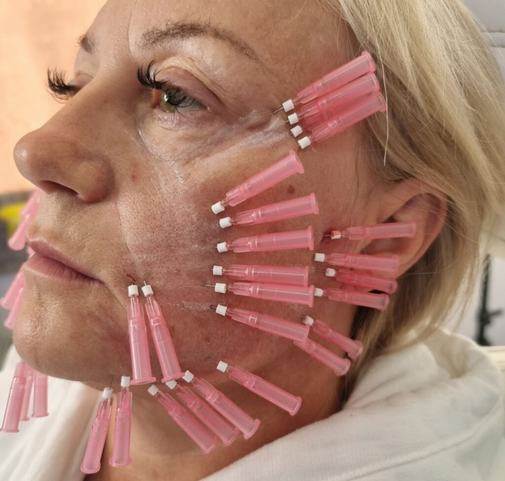 Thread skin lifting at Grazia skin clinic. 