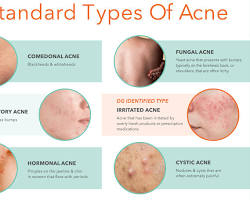 BEST ACNE TREATMENT IN DELHI.