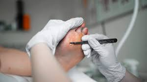 expert corn removal at Grazia.