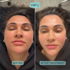 HIFU face lifting before and after results.

