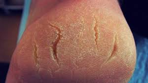 FISSURE TREATMENT AT GRAZIA SKIN CLINIC.